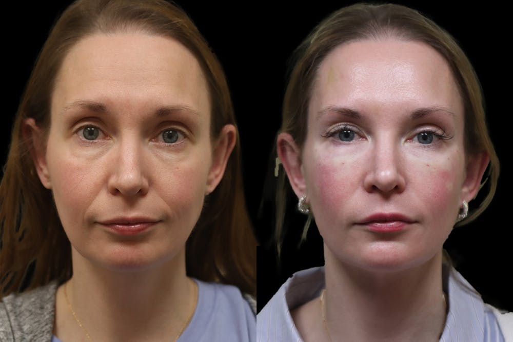Tear Trough Correction Before & After Gallery - Patient 258858 - Image 1