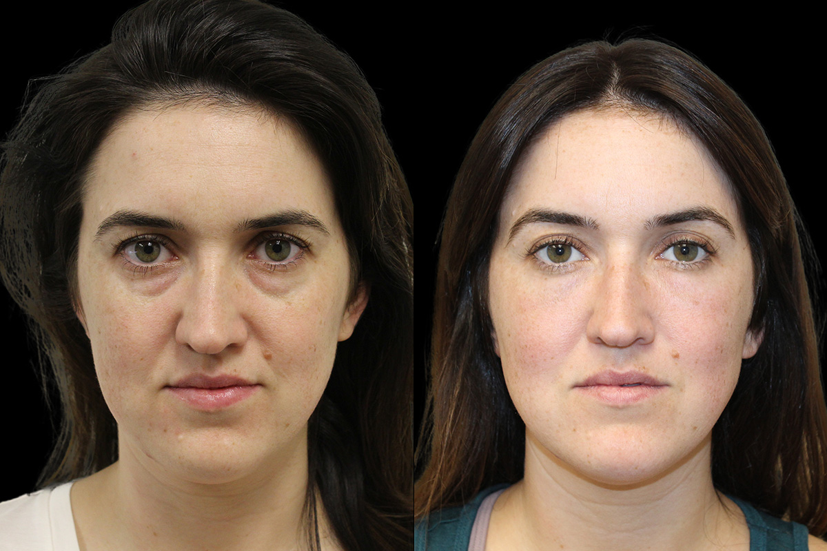 Tear Trough Correction Before & After Gallery - Patient 175560 - Image 1