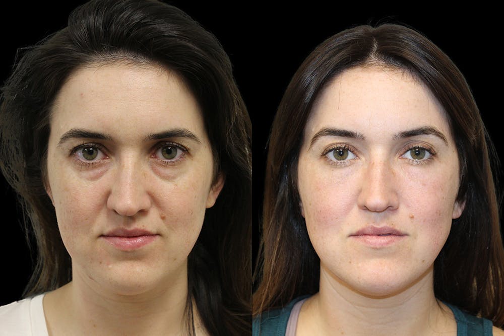Tear Trough Correction Before & After Gallery - Patient 175560 - Image 1