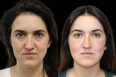 Tear Trough Correction Before & After Gallery - Patient 175560 - Image 1