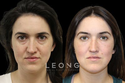 Tear Trough Correction Before & After Gallery - Patient 175560 - Image 1