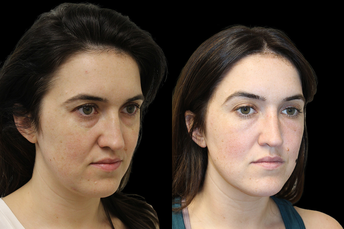 Tear Trough Correction Before & After Gallery - Patient 175560 - Image 2