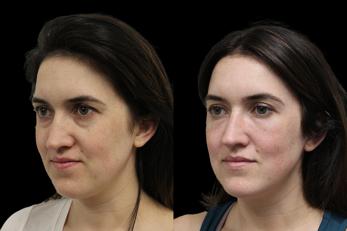 Tear Trough Correction Before & After Gallery - Patient 175560 - Image 3