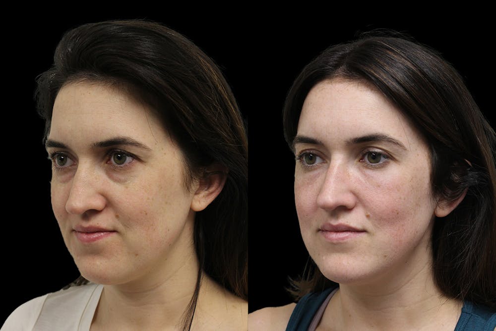 Tear Trough Correction Before & After Gallery - Patient 175560 - Image 3