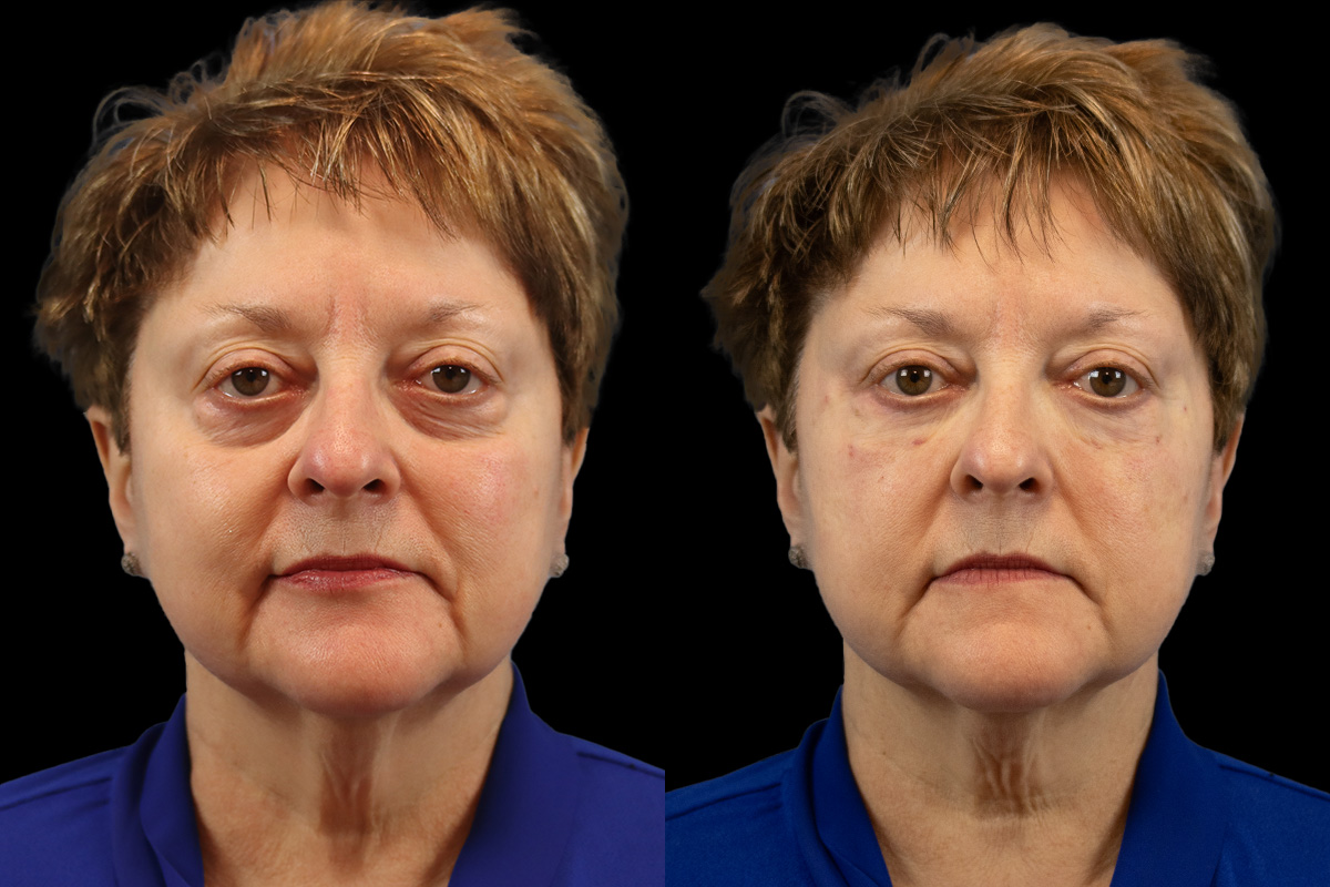 Tear Trough Correction Before & After Gallery - Patient 139067 - Image 1