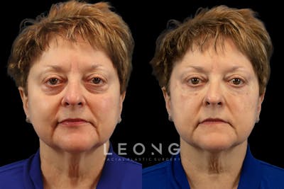 Tear Trough Correction Before & After Gallery - Patient 139067 - Image 1