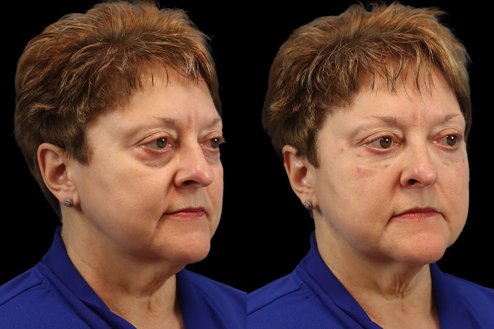 Tear Trough Correction Before & After Gallery - Patient 139067 - Image 2