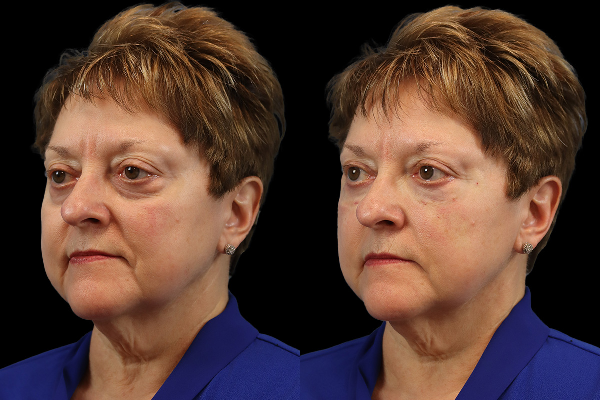 Tear Trough Correction Before & After Gallery - Patient 139067 - Image 3