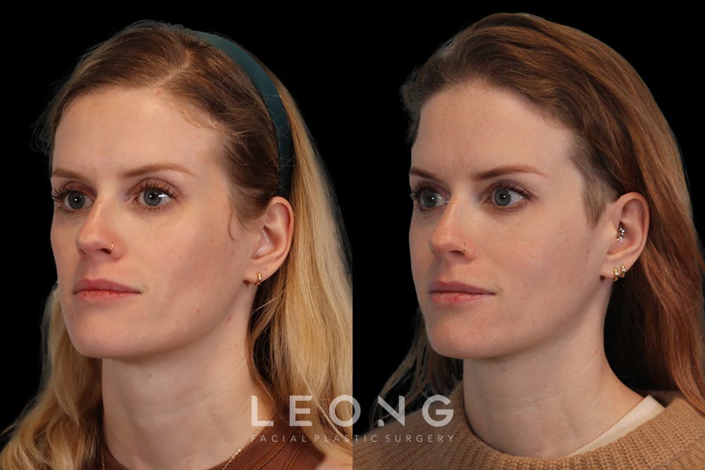 Cheeks Before & After Gallery - Patient 426657 - Image 1