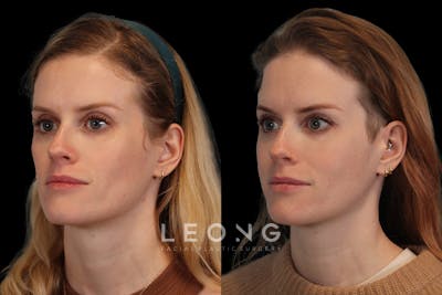 Sculptra® Before & After Gallery - Patient 4890976 - Image 1