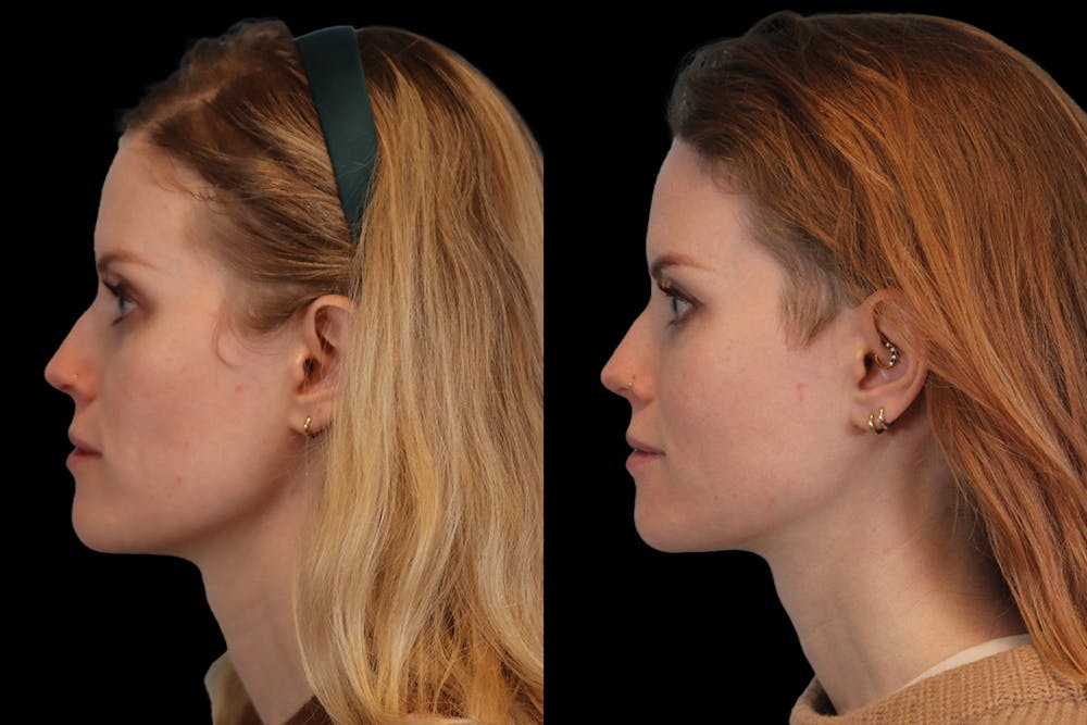 Sculptra® Before & After Gallery - Patient 4890976 - Image 2