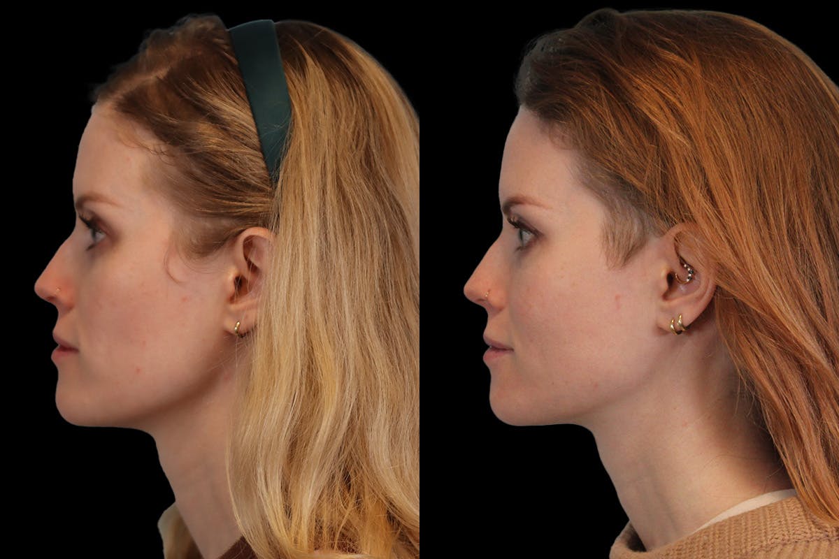 Sculptra® Before & After Gallery - Patient 4890976 - Image 2
