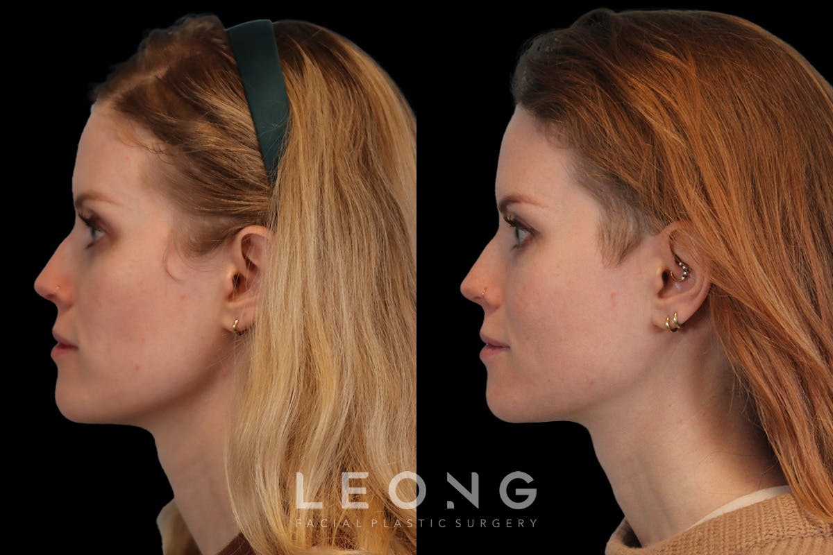 Cheeks Before & After Gallery - Patient 426657 - Image 3