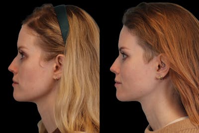 Sculptra® Before & After Gallery - Patient 4890976 - Image 2
