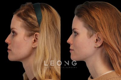 Sculptra® Before & After Gallery - Patient 4890976 - Image 2