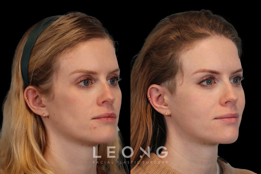 Cheeks Before & After Gallery - Patient 426657 - Image 2