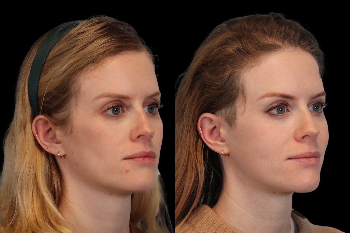 Sculptra® Before & After Gallery - Patient 4890976 - Image 3