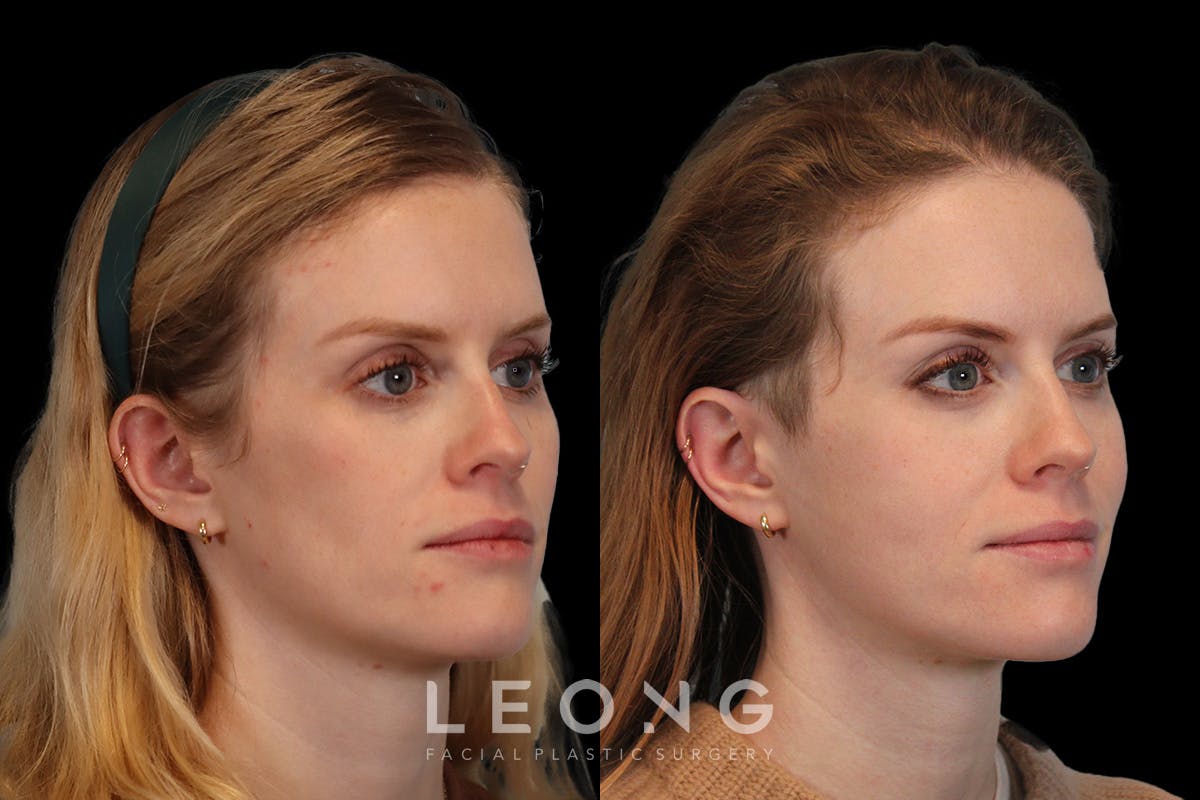 Cheeks Before & After Gallery - Patient 426657 - Image 2