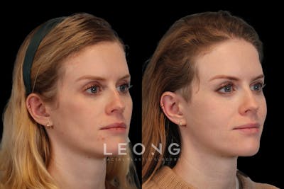 Cheeks Before & After Gallery - Patient 426657 - Image 2