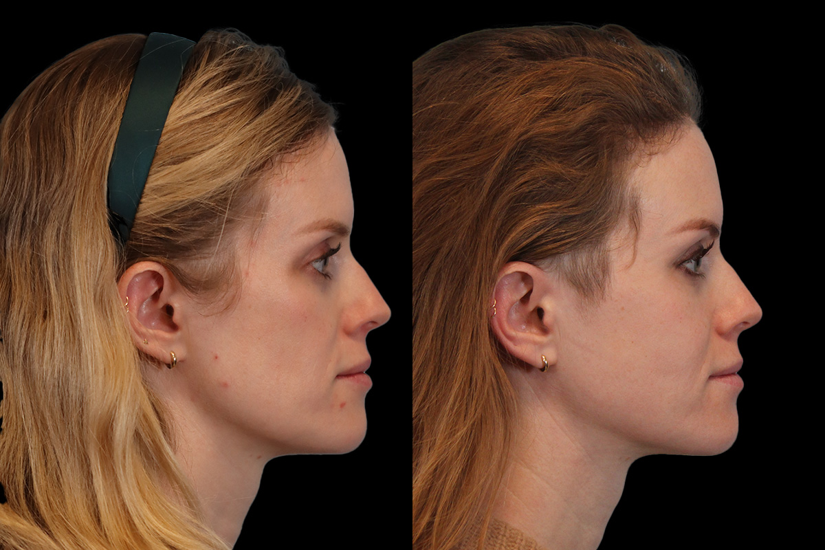 Cheeks Before & After Gallery - Patient 426657 - Image 4