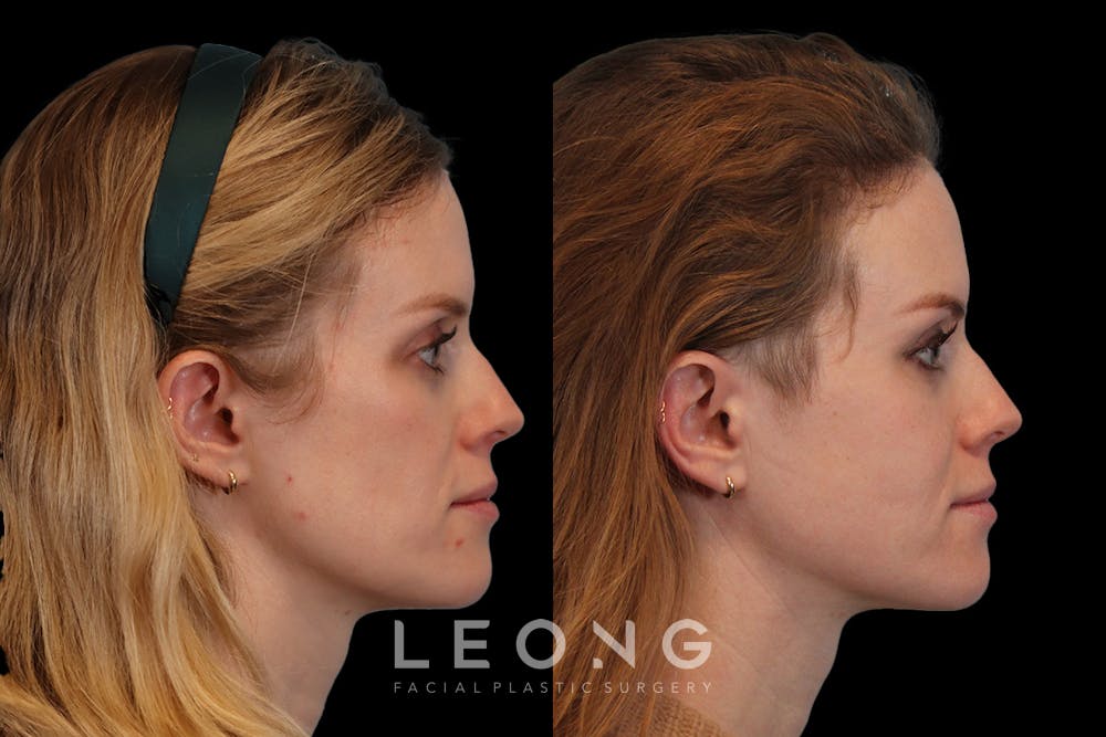 Cheeks Before & After Gallery - Patient 426657 - Image 4