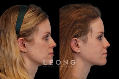 Cheeks Before & After Gallery - Patient 426657 - Image 4