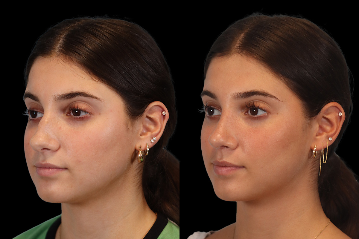 Rhinoplasty Before & After Gallery - Patient 184407 - Image 6