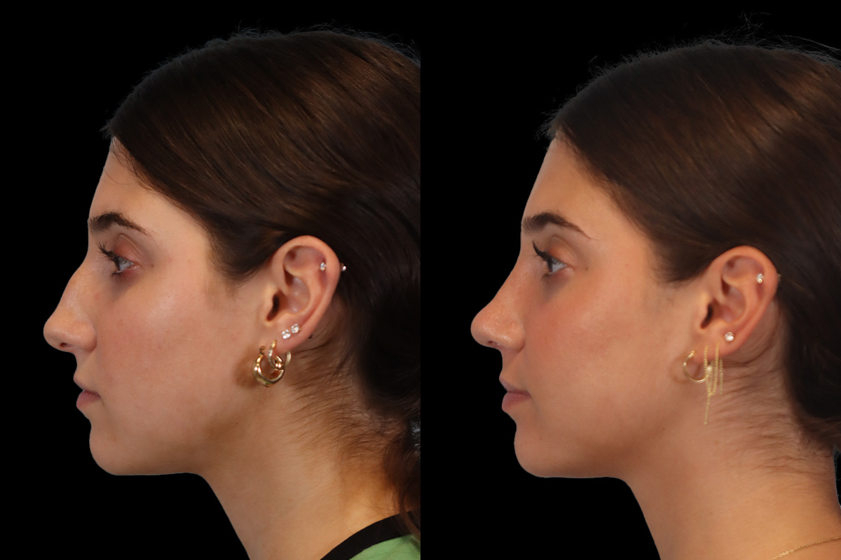 Rhinoplasty Before & After Gallery - Patient 184407 - Image 7