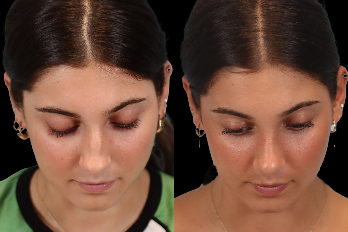 Rhinoplasty Before & After Gallery - Patient 184407 - Image 10