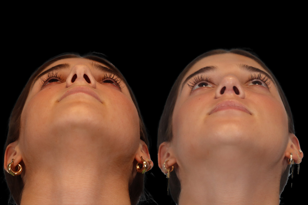 Rhinoplasty Before & After Gallery - Patient 184407 - Image 9