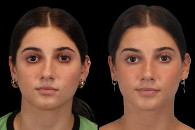 Rhinoplasty Before & After Gallery - Patient 184407 - Image 1