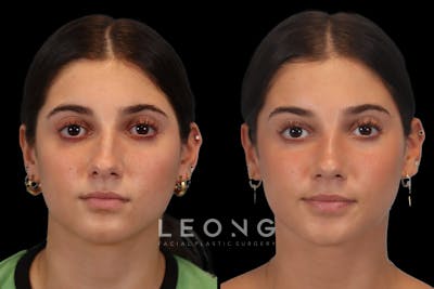 Rhinoplasty Before & After Gallery - Patient 184407 - Image 1
