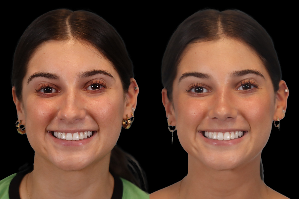 Rhinoplasty Before & After Gallery - Patient 184407 - Image 2