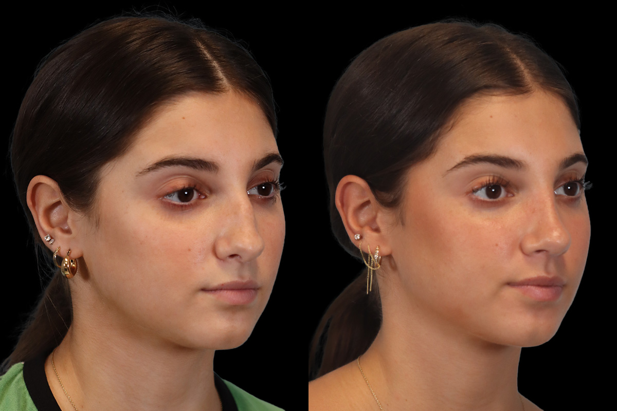Rhinoplasty Before & After Gallery - Patient 184407 - Image 3