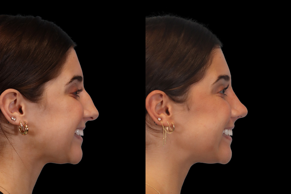 Rhinoplasty Before & After Gallery - Patient 184407 - Image 5