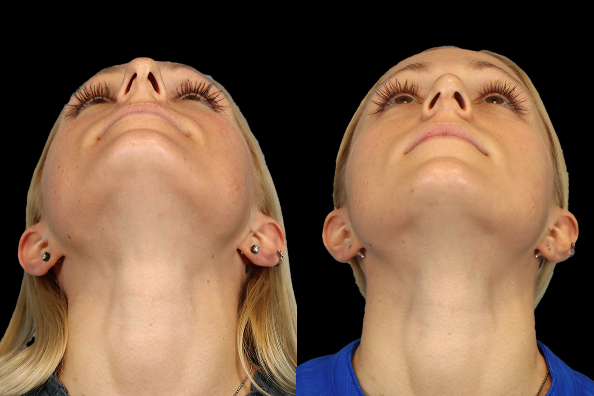 Rhinoplasty Before & After Gallery - Patient 150189 - Image 8