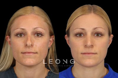 Rhinoplasty Before & After Gallery - Patient 150189 - Image 1