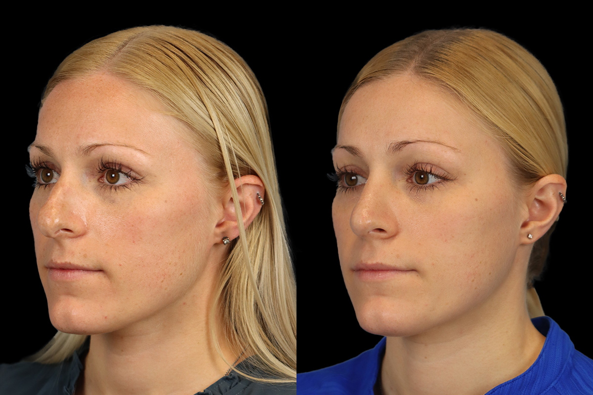 Rhinoplasty Before & After Gallery - Patient 150189 - Image 5