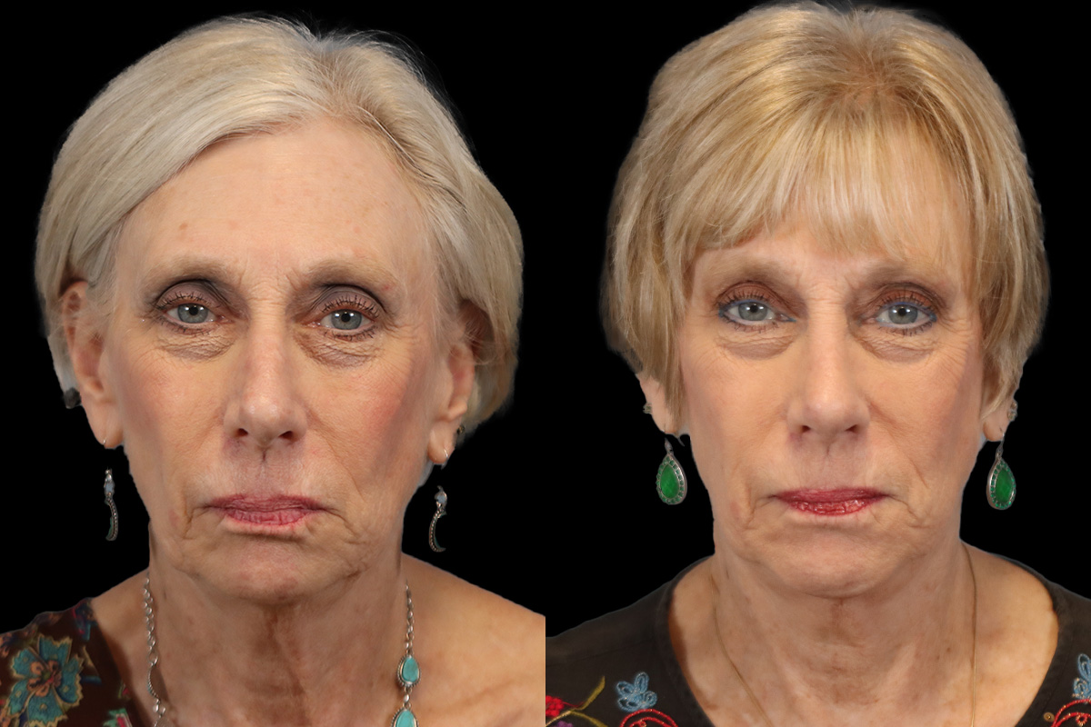 Rhinoplasty Before & After Gallery - Patient 274088 - Image 1