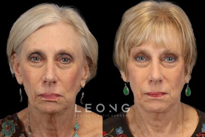 Rhinoplasty Before & After Gallery - Patient 274088 - Image 1