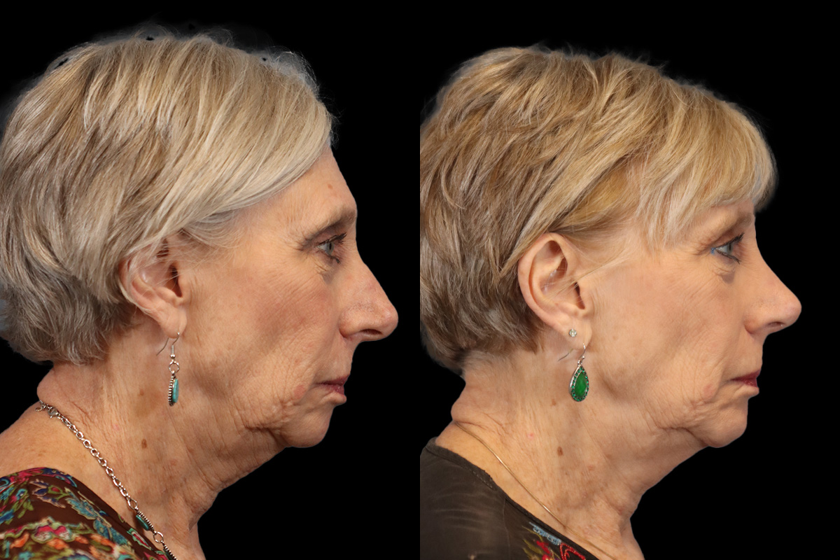 Rhinoplasty Before & After Gallery - Patient 274088 - Image 3