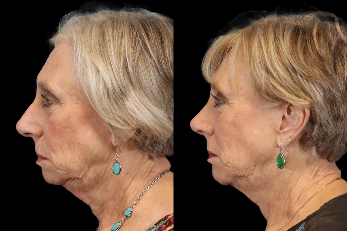 Rhinoplasty Before & After Gallery - Patient 274088 - Image 5