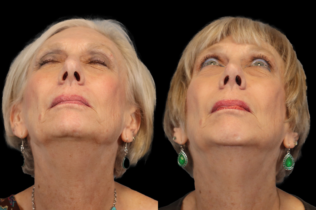 Rhinoplasty Before & After Gallery - Patient 274088 - Image 7