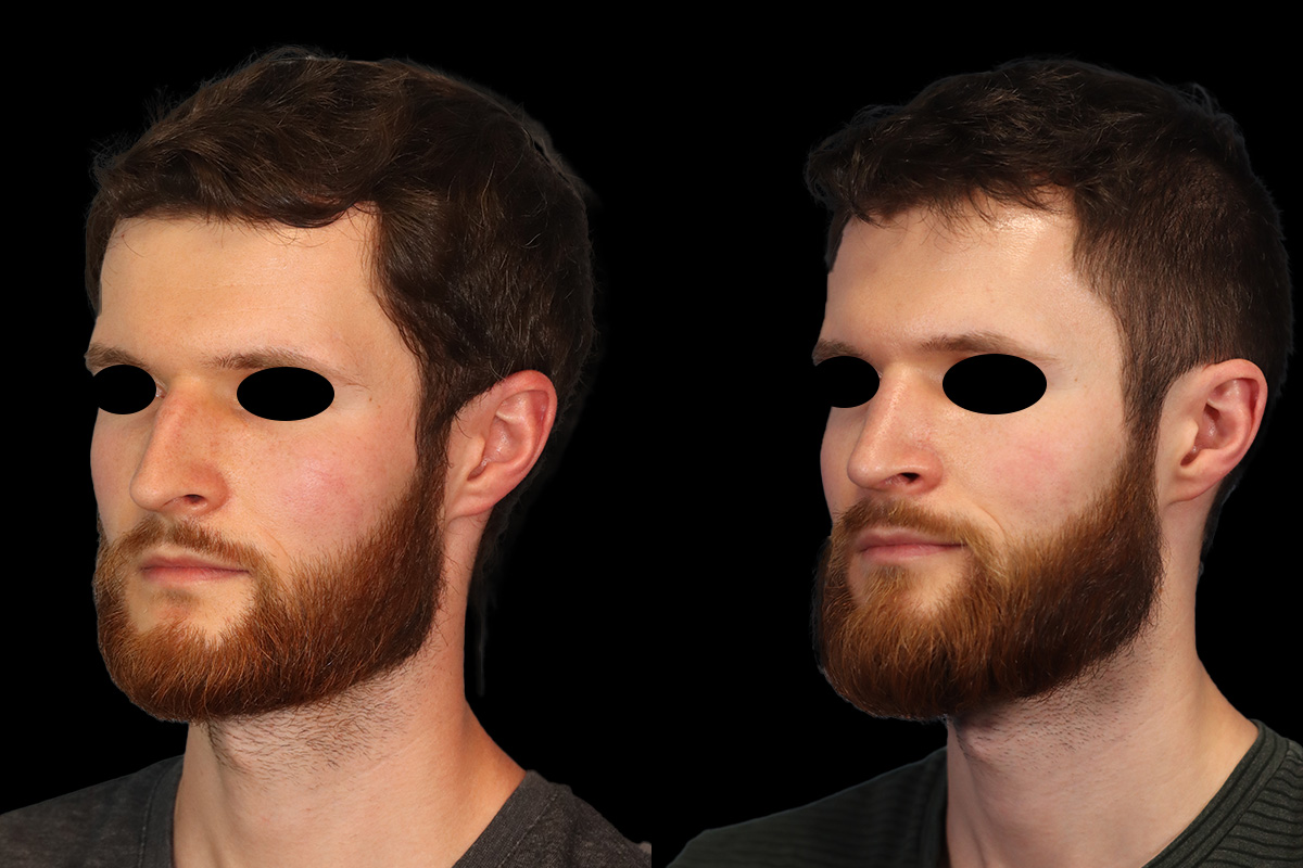 Rhinoplasty Before & After Gallery - Patient 116635 - Image 2