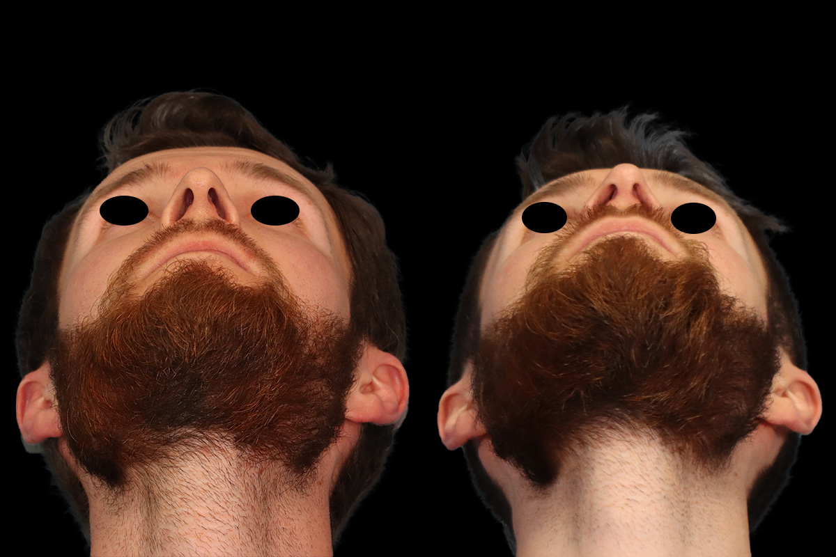 Rhinoplasty Before & After Gallery - Patient 116635 - Image 1