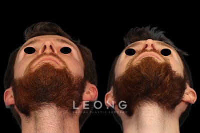 Rhinoplasty Before & After Gallery - Patient 116635 - Image 1