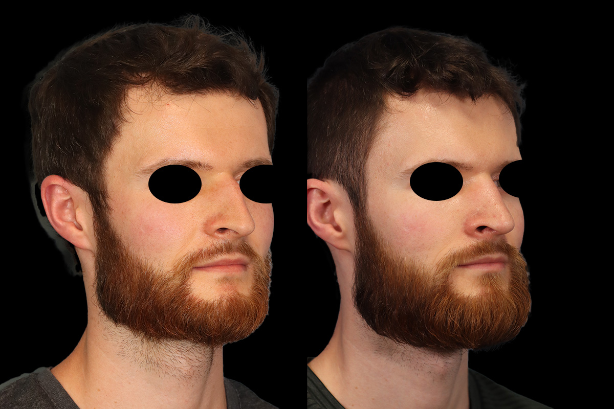 Rhinoplasty Before & After Gallery - Patient 116635 - Image 3