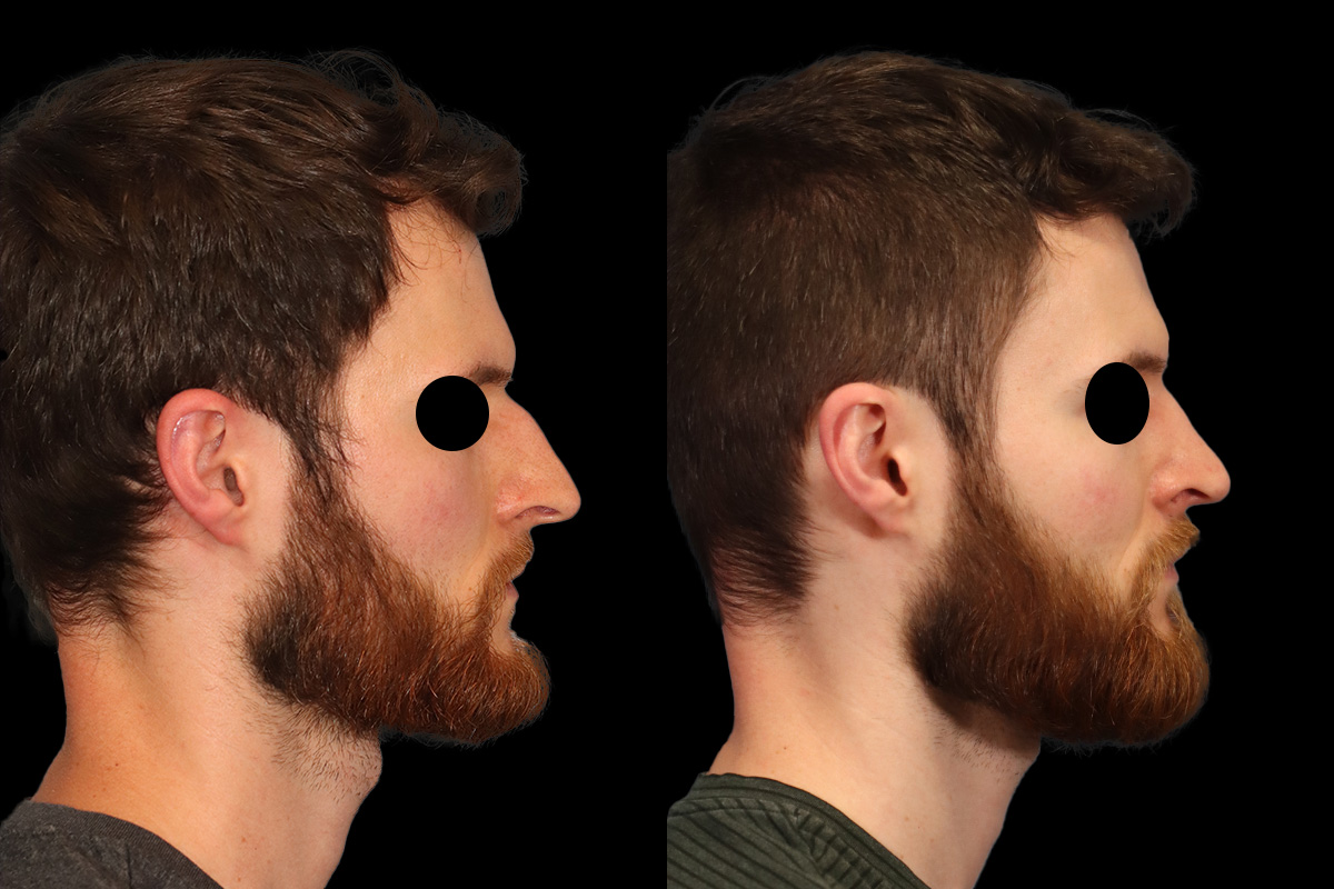 Rhinoplasty Before & After Gallery - Patient 116635 - Image 5