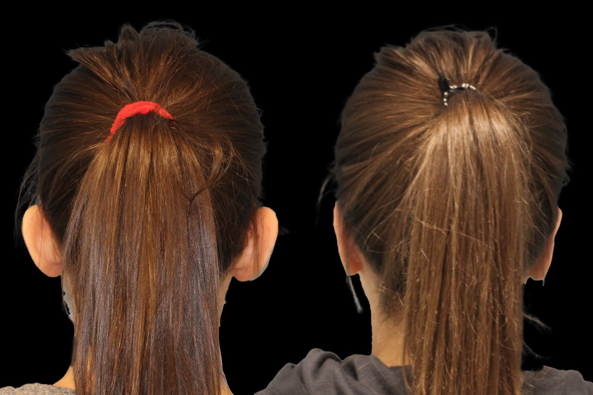 Ears Before & After Gallery - Patient 387797 - Image 4