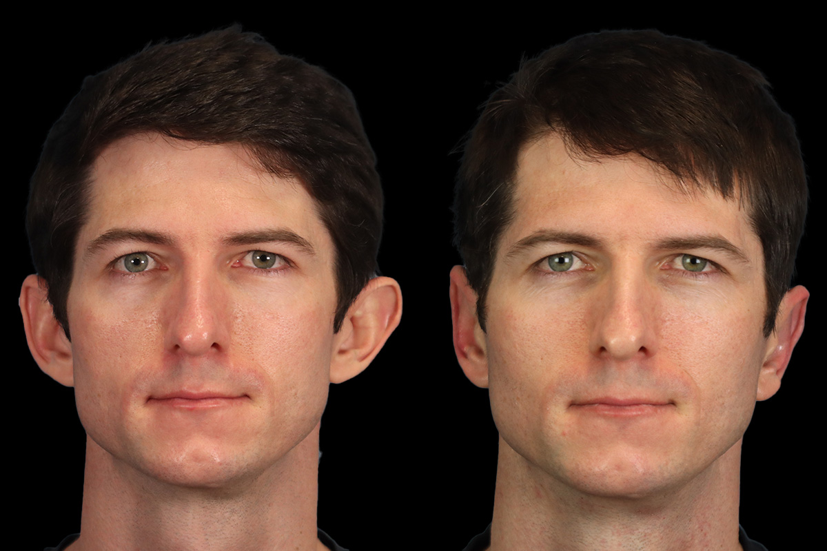 Otoplasty Before & After Gallery - Patient 107066 - Image 1